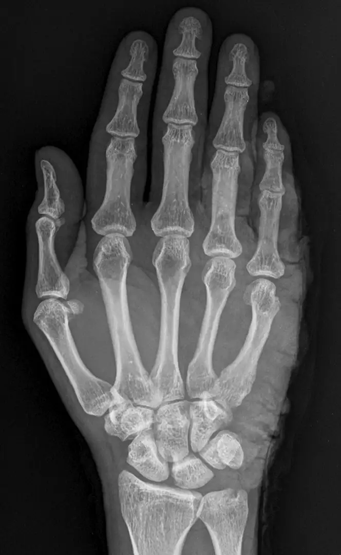 X-Ray of hand