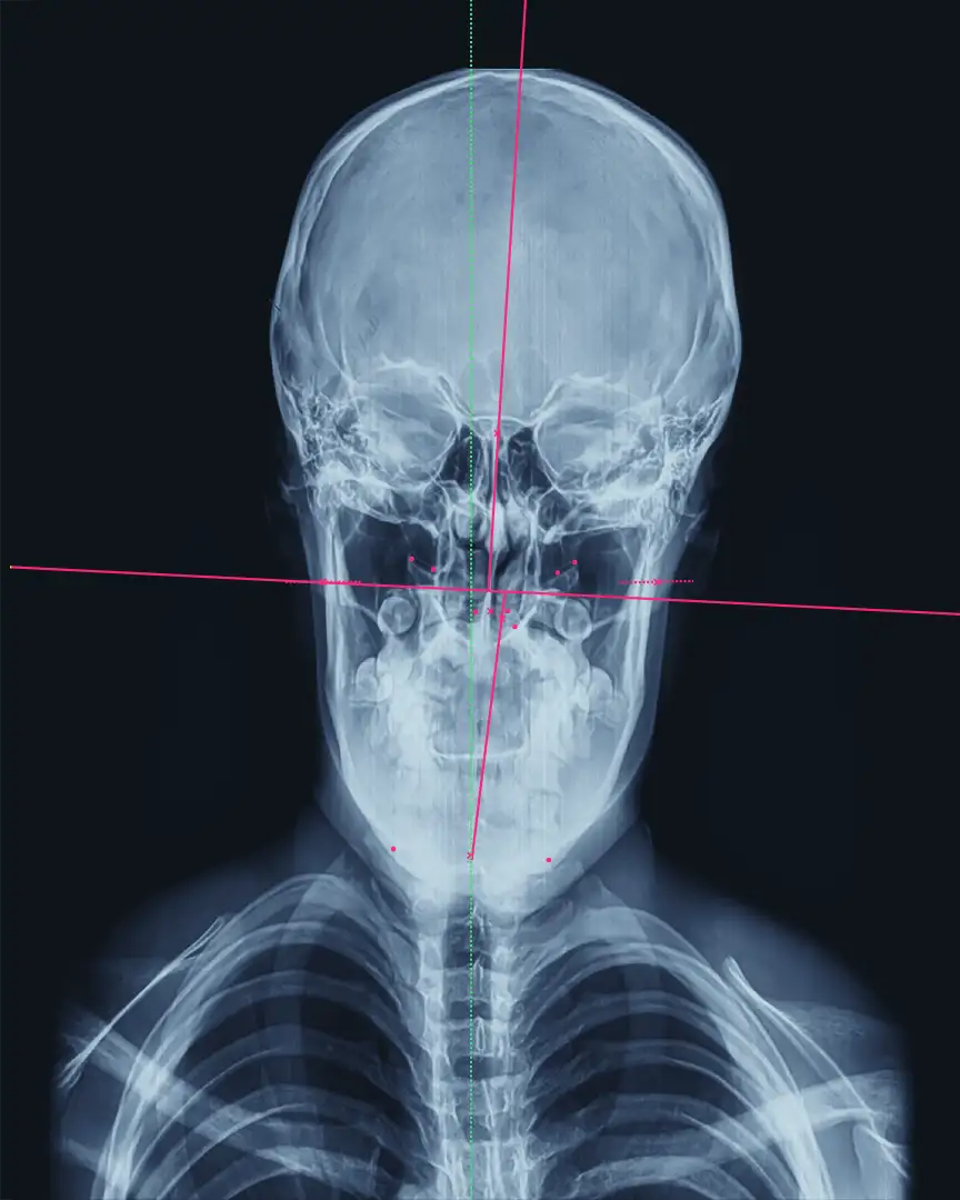 Frontal X-ray of severe misalignment of the spine
