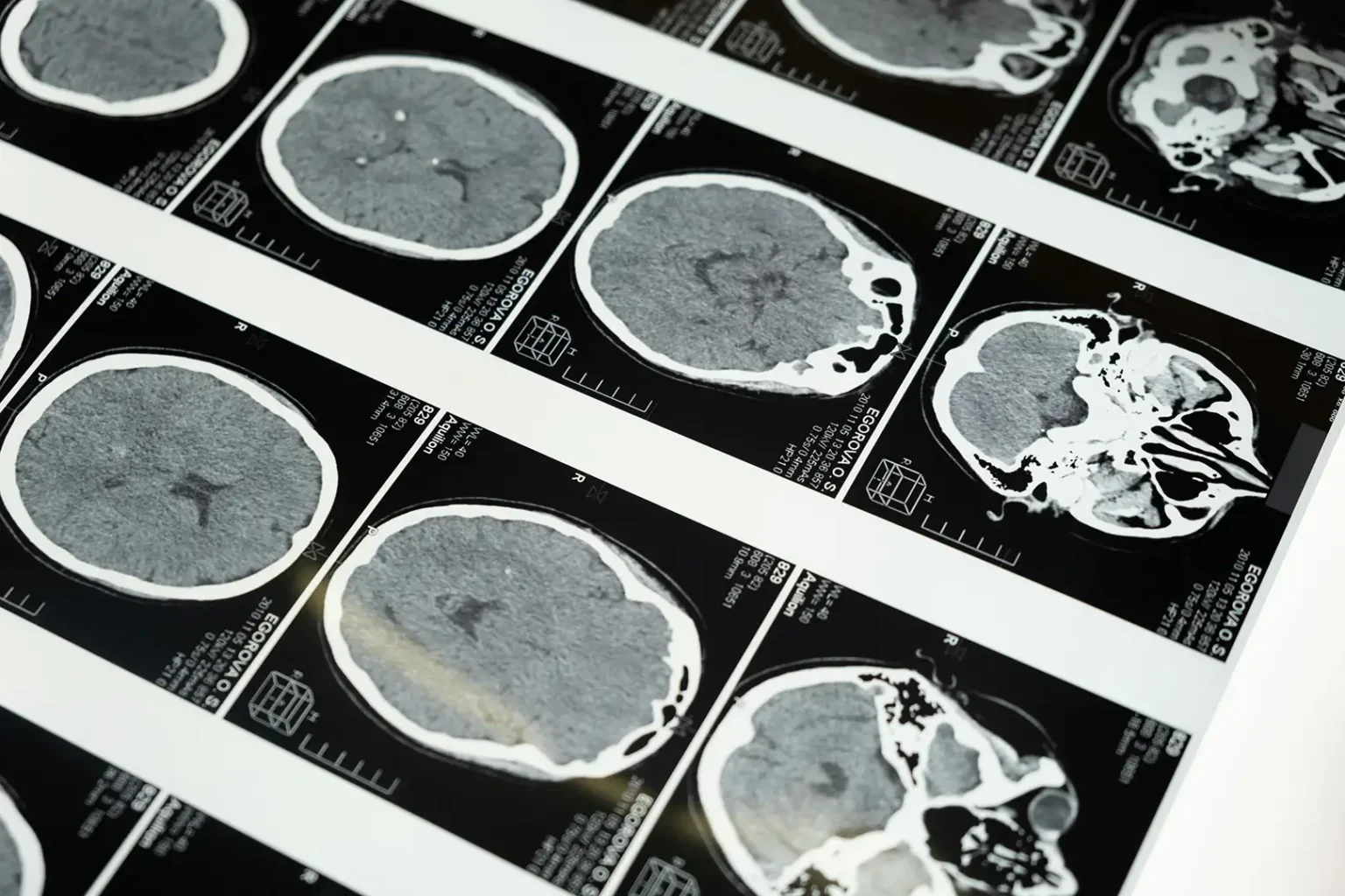 Detailed brain MRI scans displayed on a lightbox, showcasing medical imaging techniques